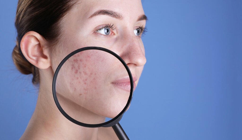 Skin Conditions